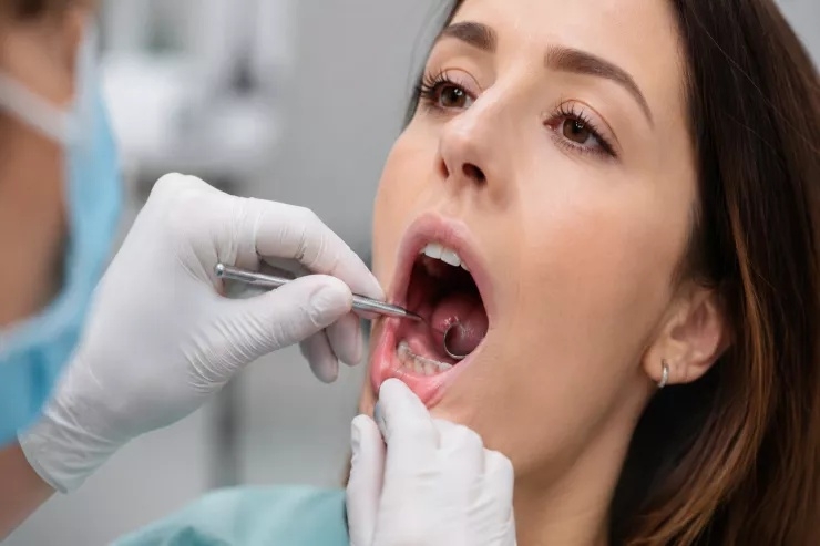 Ağız xərçəngi çox vaxt nəzərə çarpmayan bir əlamətlə başlayır - nəyə diqqət yetirmək lazımdır?