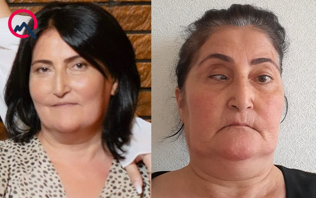 Bu klinika təzminat ödəyəcək - Burun düzəldəndə gözü zədələyib